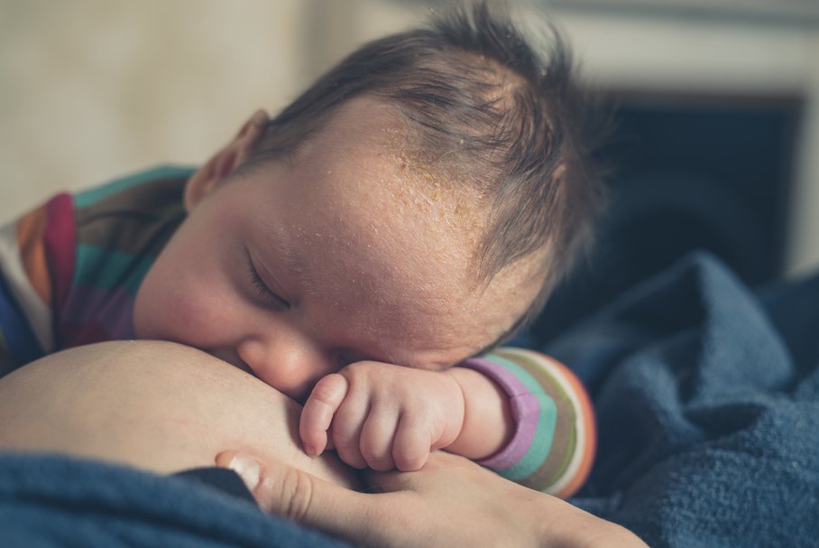 Łojotokowe zapalenie skóry u niemowląt – objawy, czym smarować, domowe sposoby