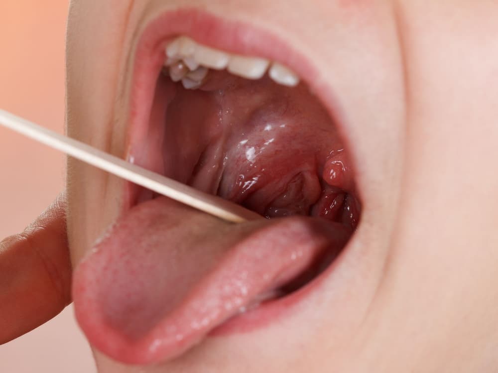 Angina ropna u dziecka – objawy, leczenie w domu, antybiotyk