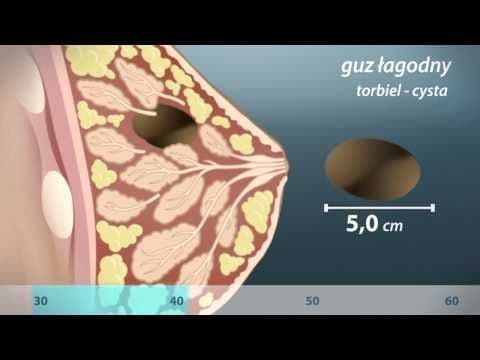 Guzki w piersiach: jak rozpoznać guzy piersi - video