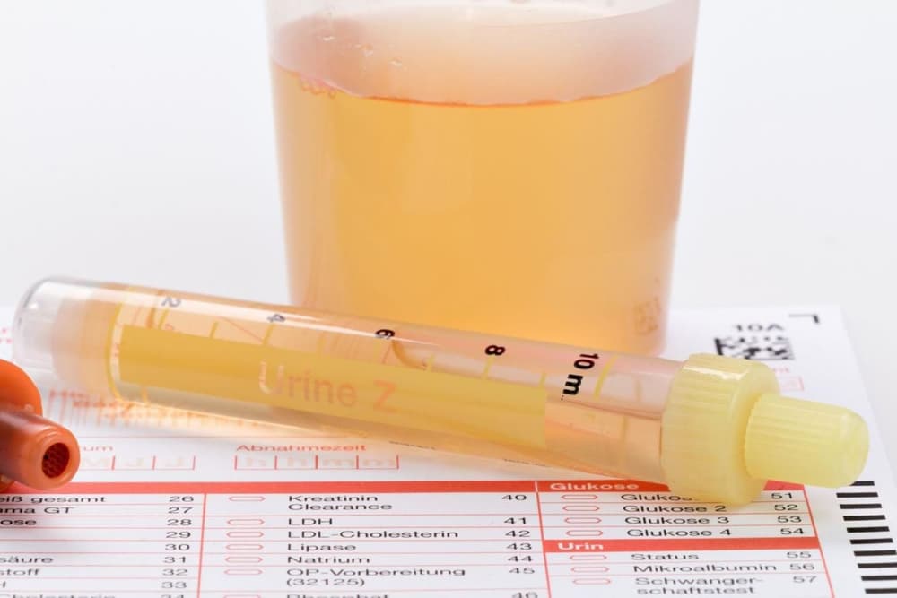 Leukocyty w moczu w ciąży (leukocyturia) – co oznaczają białe krwinki w badaniu moczu w ciąży?
