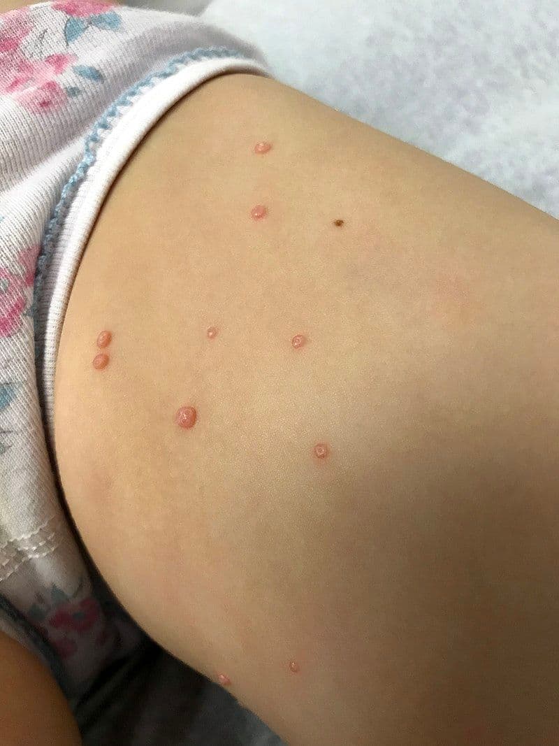 Mięczak zakaźny u dzieci – objawy, leczenie, zarażanie
