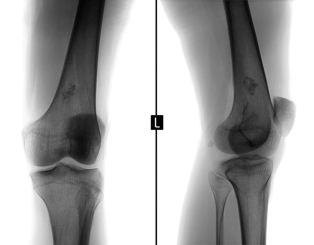 Mięsak Ewinga – przyczyny, objawy, diagnostyka, leczenie, rokowania