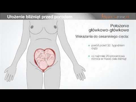Położenie bliźniąt w macicy - video