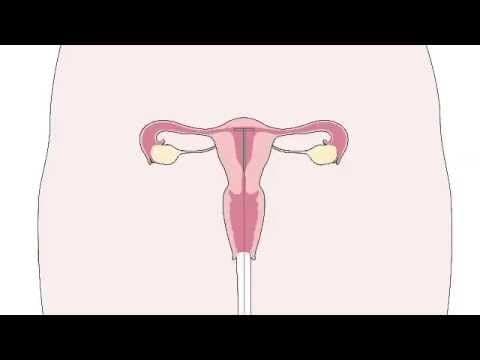 Spirala: zakładanie wkładki wewnątrzmacicznej - video